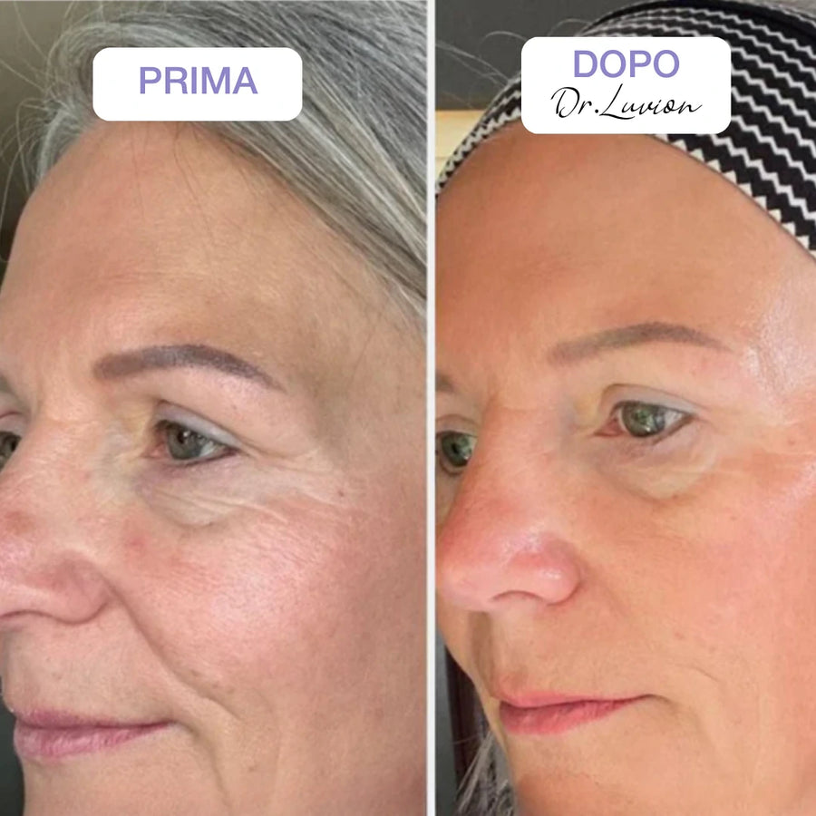 Before and after Dr.Luvion Smoothing PDRN Face Mask: softer crow's feet and smoother skin around the eyes