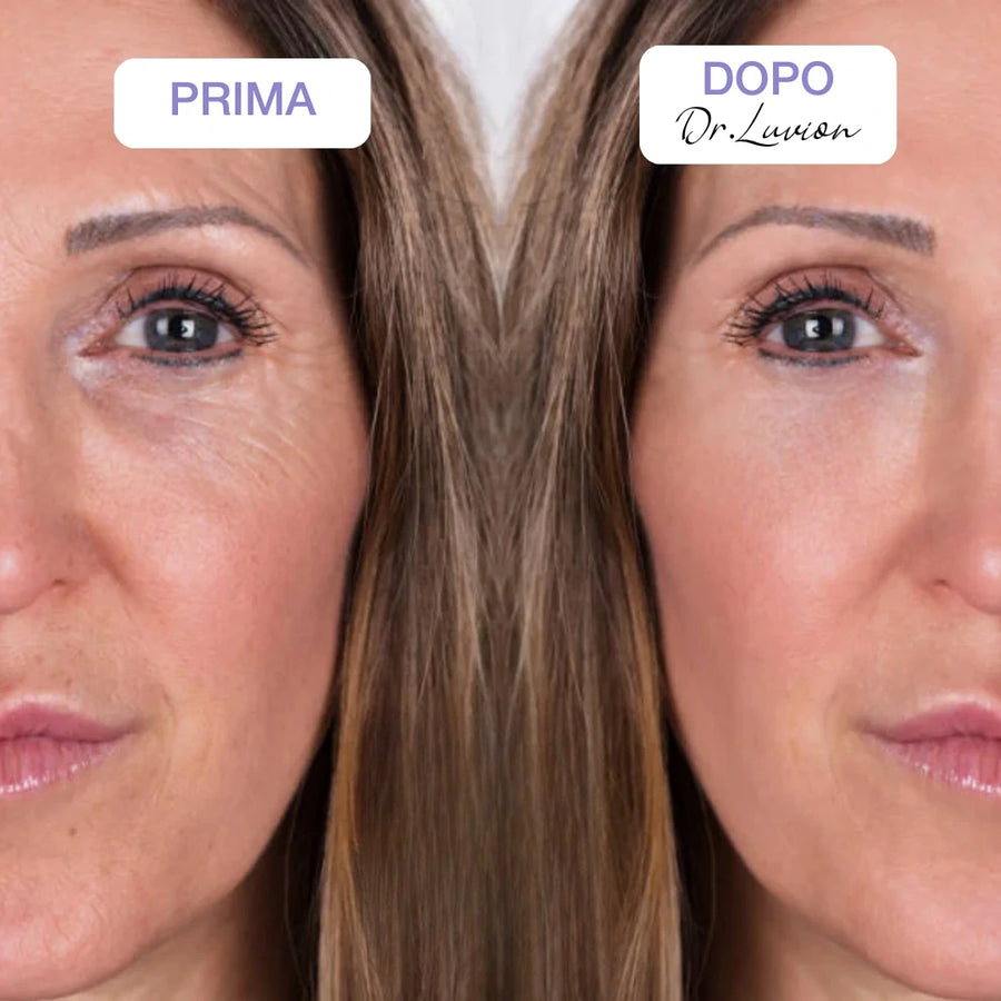 Before and after Dr.Luvion PDRN Face Mask: visibly smoother skin and softer fine lines around the eye area