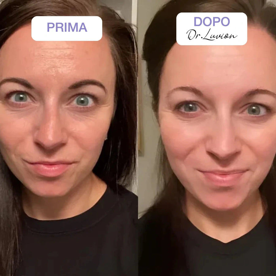 Before and after Dr.Luvion PDRN Face Mask: smoother forehead and a brighter, more even-looking complexion
